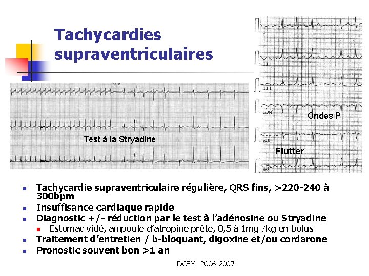 Tachycardies supraventriculaires Ondes P Test à la Stryadine Flutter n n n Tachycardie supraventriculaire