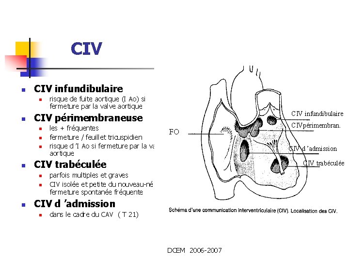 CIV n CIV infundibulaire n n les + fréquentes FO fermeture / feuillet tricuspidien