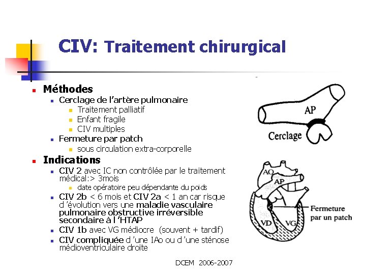 CIV: Traitement chirurgical n Méthodes n n n Cerclage de l’artère pulmonaire n Traitement