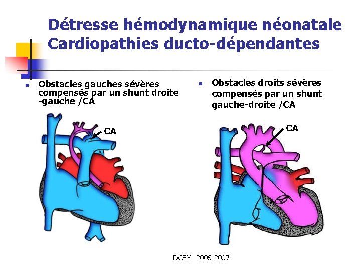 Détresse hémodynamique néonatale Cardiopathies ducto-dépendantes n Obstacles gauches sévères compensés par un shunt droite Détresse hémodynamique néonatale Cardiopathies ducto-dépendantes n Obstacles gauches sévères compensés par un shunt droite