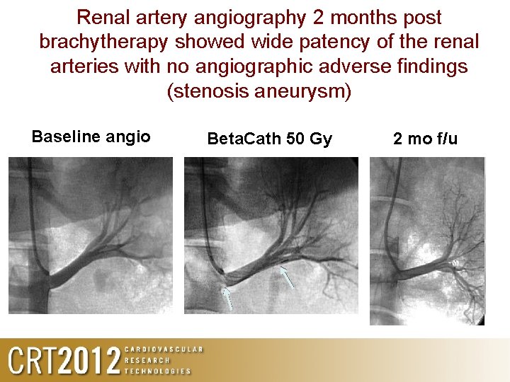 Renal artery angiography 2 months post brachytherapy showed wide patency of the renal arteries