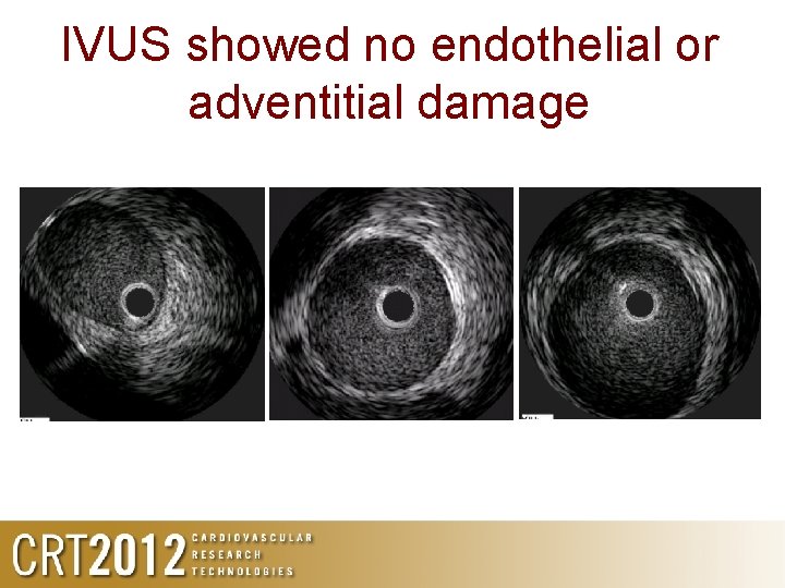 IVUS showed no endothelial or adventitial damage 