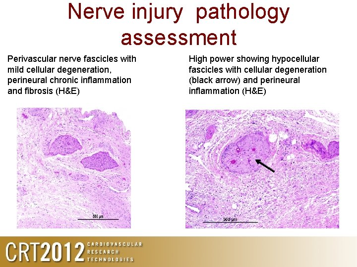 Nerve injury pathology assessment Perivascular nerve fascicles with mild cellular degeneration, perineural chronic inflammation