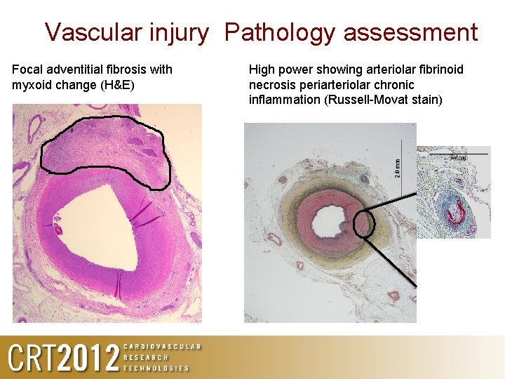 Vascular injury Pathology assessment Focal adventitial fibrosis with myxoid change (H&E) High power showing