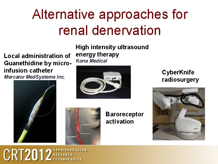 Alternative approaches for renal denervation High intensity ultrasound Local administration of energy therapy Guanethidine
