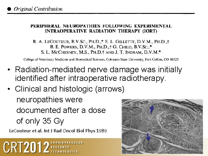  • Radiation-mediated nerve damage was initially identified after intraoperative radiotherapy. • Clinical and