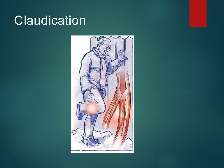 Claudication 