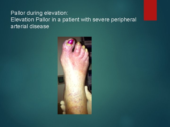 Pallor during elevation: Elevation Pallor in a patient with severe peripheral arterial disease 