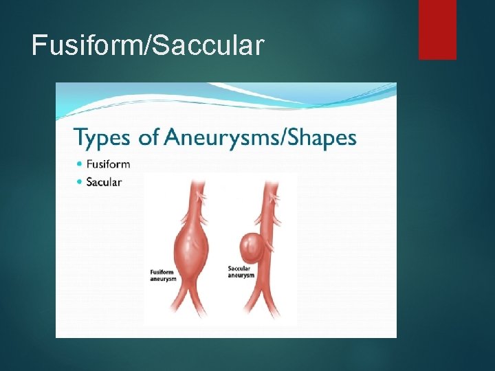Fusiform/Saccular 