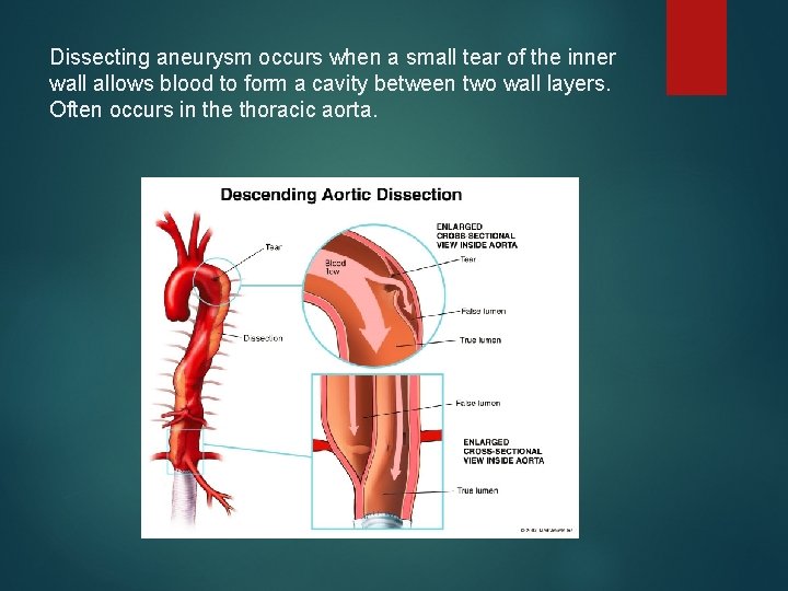 Dissecting aneurysm occurs when a small tear of the inner wall allows blood to