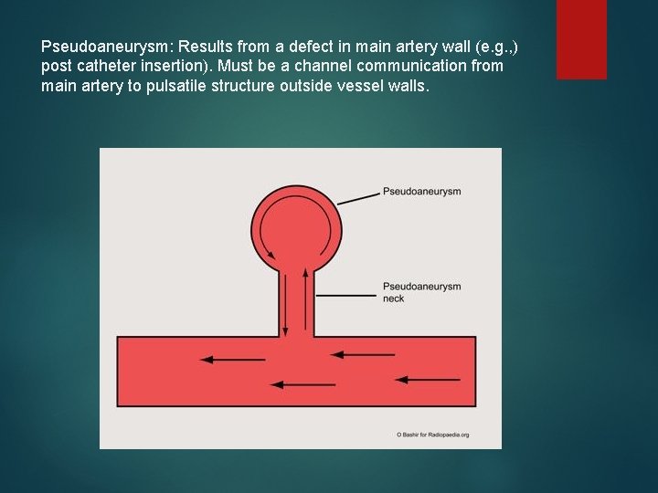Pseudoaneurysm: Results from a defect in main artery wall (e. g. , ) post