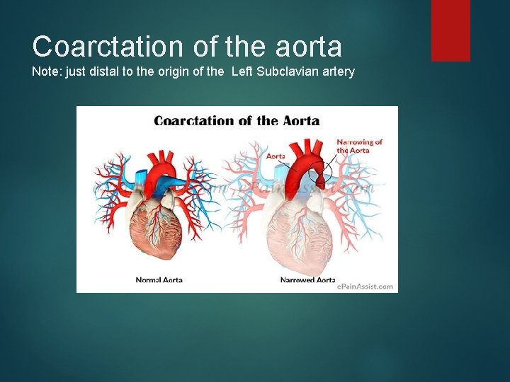 Coarctation of the aorta Note: just distal to the origin of the Left Subclavian