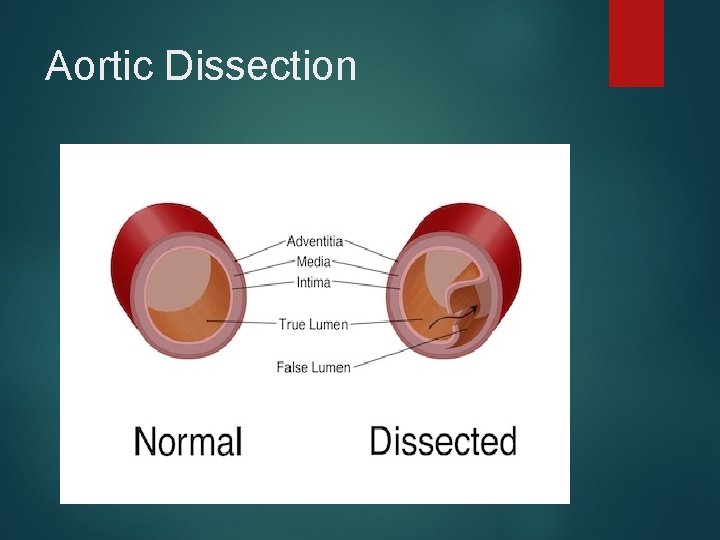 Aortic Dissection 