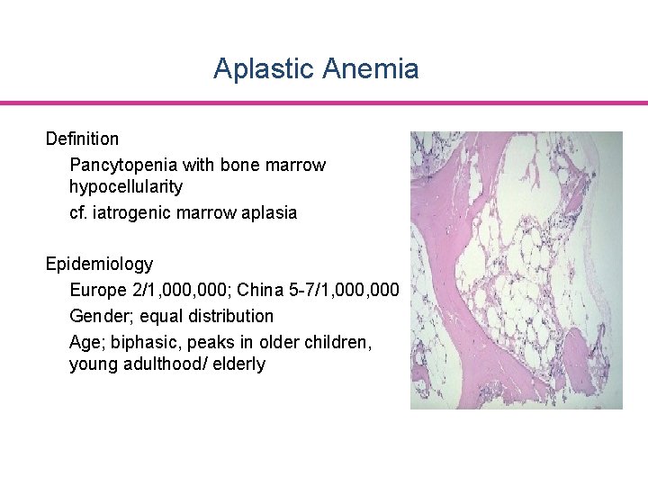 Aplastic Anemia Definition Pancytopenia with bone marrow hypocellularity cf. iatrogenic marrow aplasia Epidemiology Europe