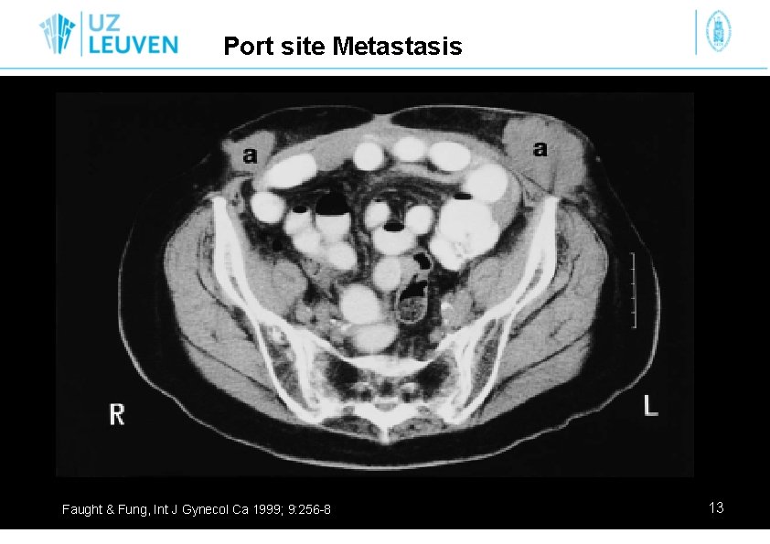 Port site Metastasis Faught & Fung, Int J Gynecol Ca 1999; 9: 256 -8