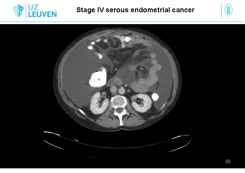 Stage IV serous endometrial cancer 38 