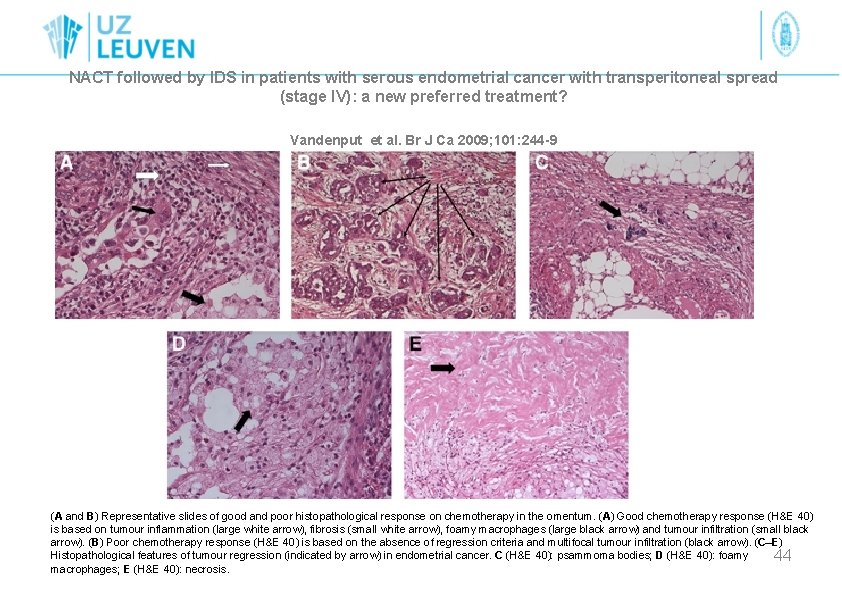 NACT followed by IDS in patients with serous endometrial cancer with transperitoneal spread (stage