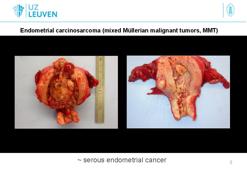 Endometrial carcinosarcoma (mixed Müllerian malignant tumors, MMT) ~ serous endometrial cancer 8 