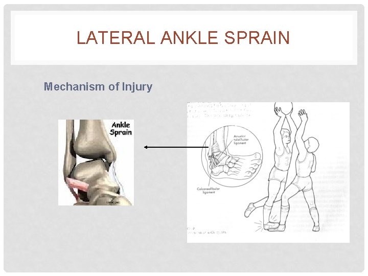 LATERAL ANKLE SPRAIN Mechanism of Injury 