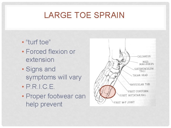 LARGE TOE SPRAIN • “turf toe” • Forced flexion or extension • Signs and
