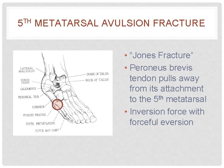 5 TH METATARSAL AVULSION FRACTURE • “Jones Fracture” • Peroneus brevis tendon pulls away