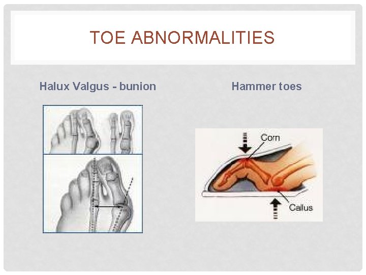 TOE ABNORMALITIES Halux Valgus - bunion Hammer toes 