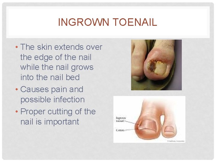 INGROWN TOENAIL • The skin extends over the edge of the nail while the