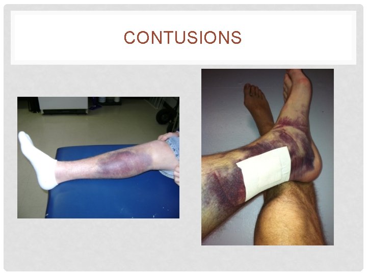 CONTUSIONS 