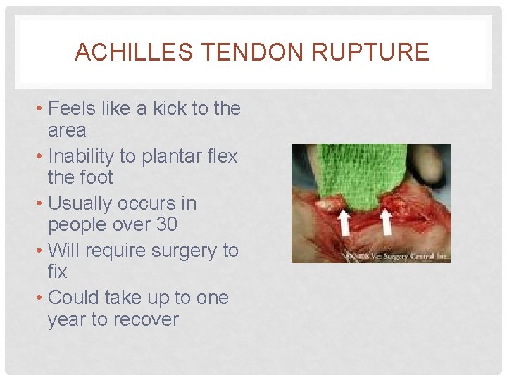 ACHILLES TENDON RUPTURE • Feels like a kick to the area • Inability to