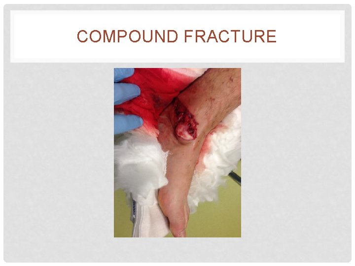 COMPOUND FRACTURE 