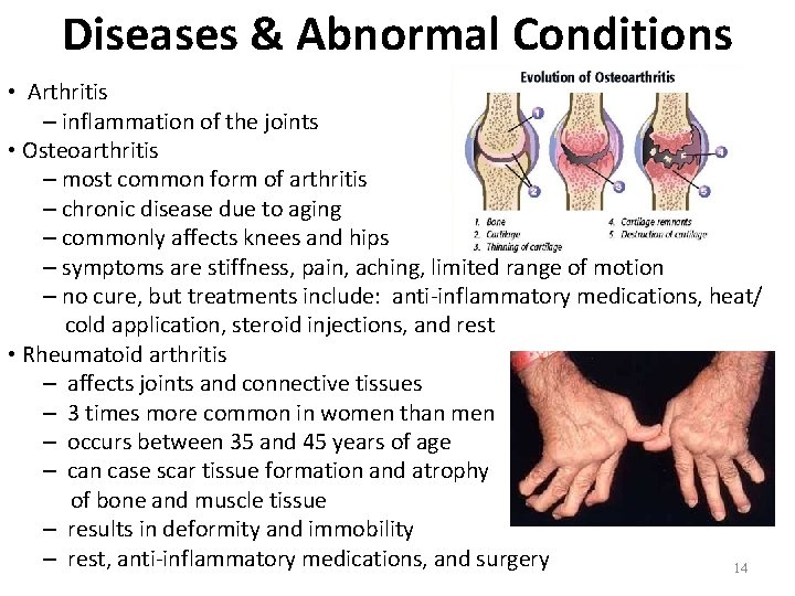Diseases & Abnormal Conditions • Arthritis – inflammation of the joints • Osteoarthritis – Diseases & Abnormal Conditions • Arthritis – inflammation of the joints • Osteoarthritis –
