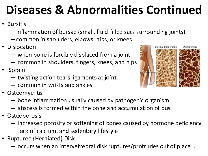 Diseases & Abnormalities Continued • Bursitis – inflammation of bursae (small, fluid-filled sacs surrounding Diseases & Abnormalities Continued • Bursitis – inflammation of bursae (small, fluid-filled sacs surrounding