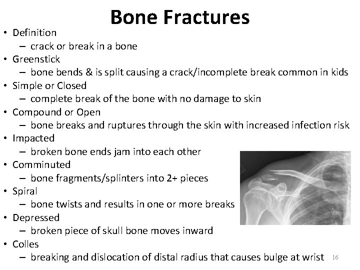Bone Fractures • Definition – crack or break in a bone • Greenstick – Bone Fractures • Definition – crack or break in a bone • Greenstick –