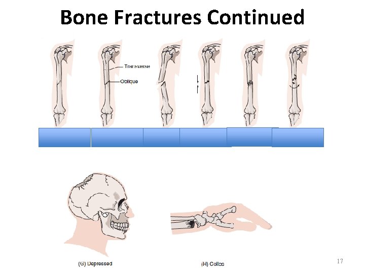 Bone Fractures Continued 17 Bone Fractures Continued 17