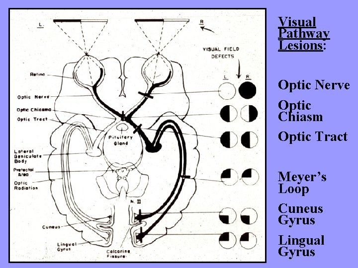 Visual Pathway Lesions: Optic Nerve Optic Chiasm Optic Tract Meyer’s Loop Cuneus Gyrus Lingual