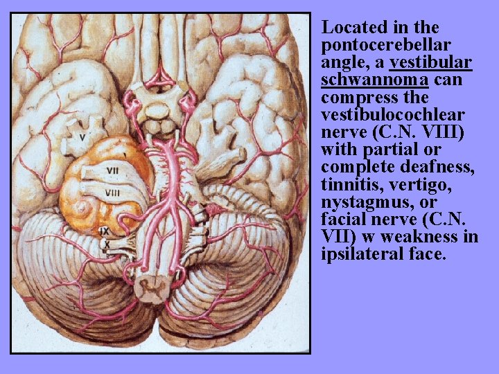 Located in the pontocerebellar angle, a vestibular schwannoma can compress the vestibulocochlear nerve (C.
