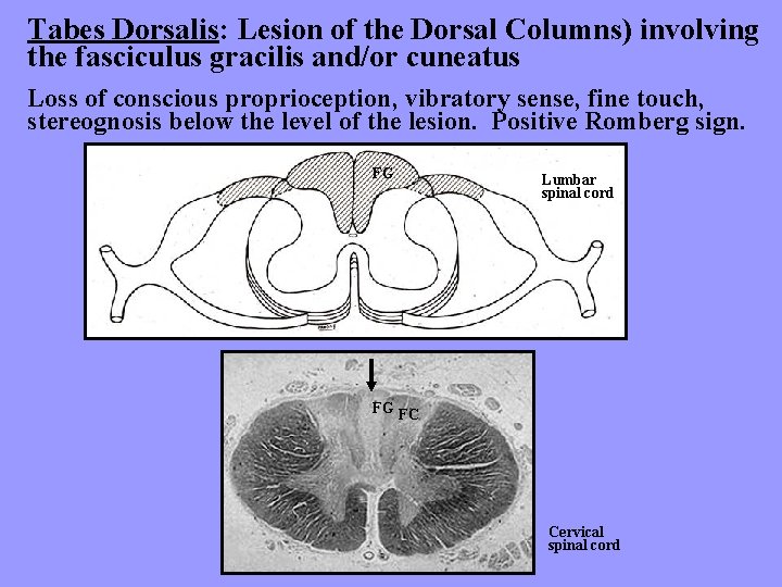 Tabes Dorsalis: Lesion of the Dorsal Columns) involving the fasciculus gracilis and/or cuneatus Loss