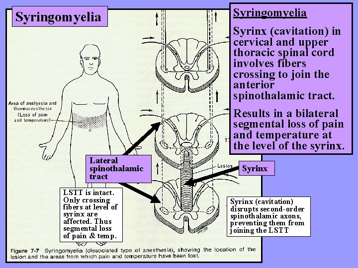 Syringomyelia Syrinx (cavitation) in cervical and upper thoracic spinal cord involves fibers crossing to