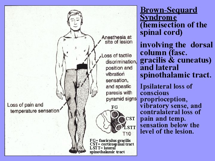 Brown-Sequard Syndrome (hemisection of the spinal cord) involving the dorsal column (fasc. gracilis &
