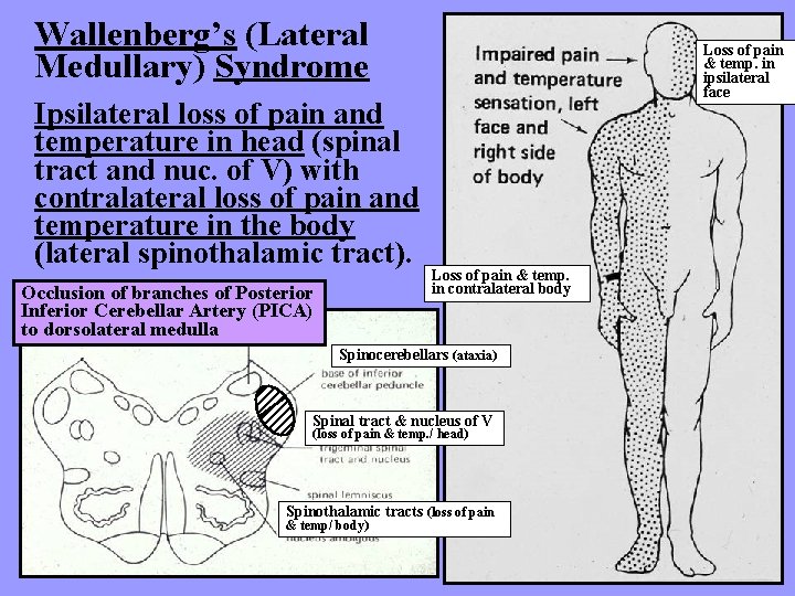 Wallenberg’s (Lateral Medullary) Syndrome Ipsilateral loss of pain and temperature in head (spinal tract