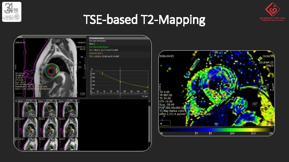 TSE-based T 2 -Mapping 