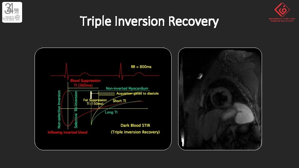 Triple Inversion Recovery 