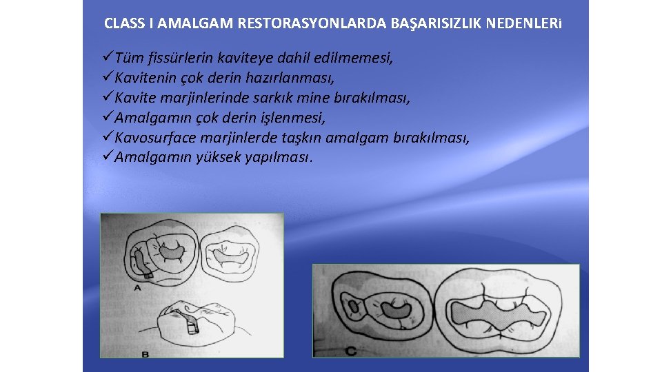 CLASS I AMALGAM RESTORASYONLARDA BAŞARISIZLIK NEDENLER İ üTüm fissürlerin kaviteye dahil edilmemesi, üKavitenin çok CLASS I AMALGAM RESTORASYONLARDA BAŞARISIZLIK NEDENLER İ üTüm fissürlerin kaviteye dahil edilmemesi, üKavitenin çok