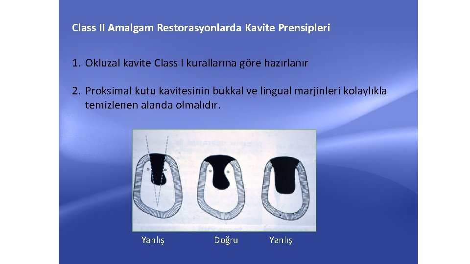 Class II Amalgam Restorasyonlarda Kavite Prensipleri 1. Okluzal kavite Class I kurallarına göre hazırlanır Class II Amalgam Restorasyonlarda Kavite Prensipleri 1. Okluzal kavite Class I kurallarına göre hazırlanır
