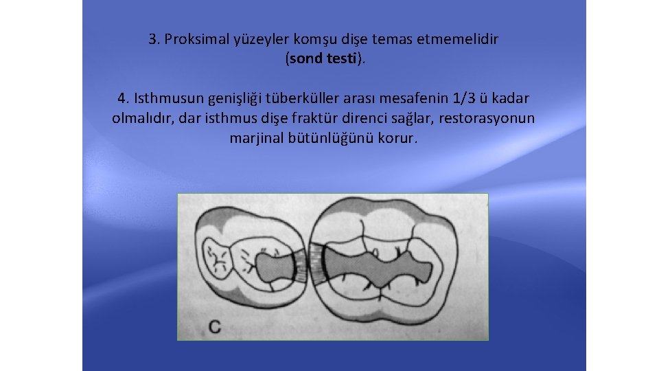 3. Proksimal yüzeyler komşu dişe temas etmemelidir (sond testi). 4. Isthmusun genişliği tüberküller arası 3. Proksimal yüzeyler komşu dişe temas etmemelidir (sond testi). 4. Isthmusun genişliği tüberküller arası