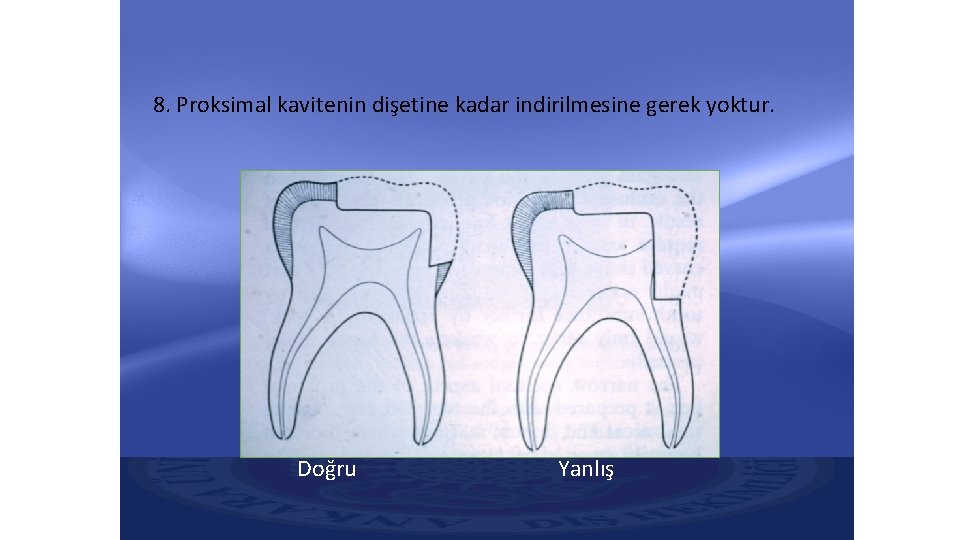 8. Proksimal kavitenin dişetine kadar indirilmesine gerek yoktur. Doğru Yanlış 8. Proksimal kavitenin dişetine kadar indirilmesine gerek yoktur. Doğru Yanlış