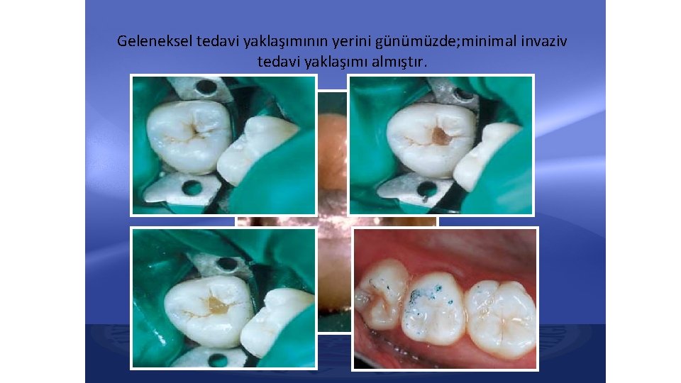 Geleneksel tedavi yaklaşımının yerini günümüzde; minimal invaziv tedavi yaklaşımı almıştır. Geleneksel tedavi yaklaşımının yerini günümüzde; minimal invaziv tedavi yaklaşımı almıştır.
