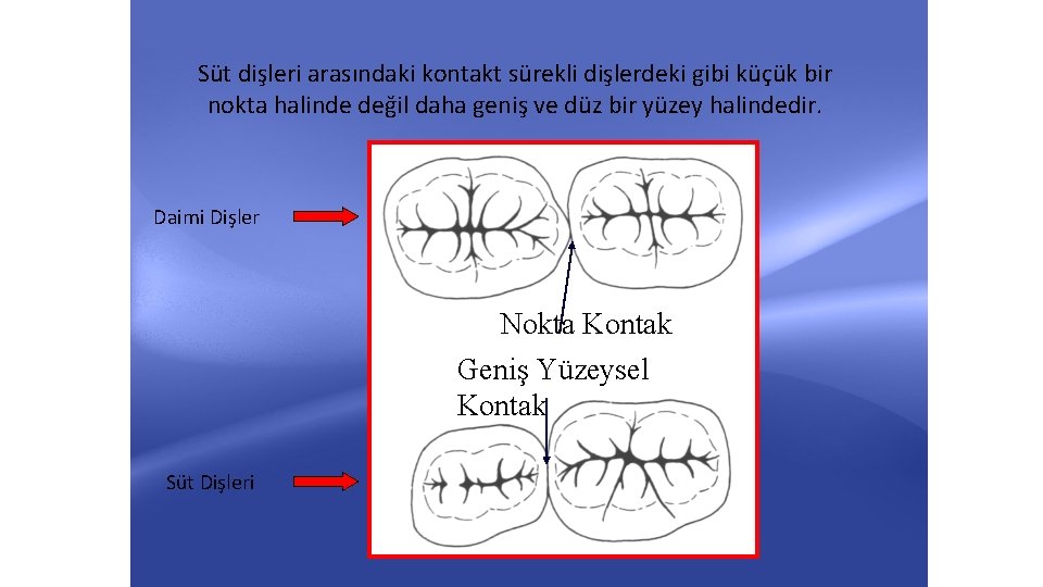 Süt dişleri arasındaki kontakt sürekli dişlerdeki gibi küçük bir nokta halinde değil daha geniş Süt dişleri arasındaki kontakt sürekli dişlerdeki gibi küçük bir nokta halinde değil daha geniş