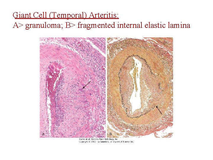 Giant Cell (Temporal) Arteritis: A> granuloma; B> fragmented internal elastic lamina 