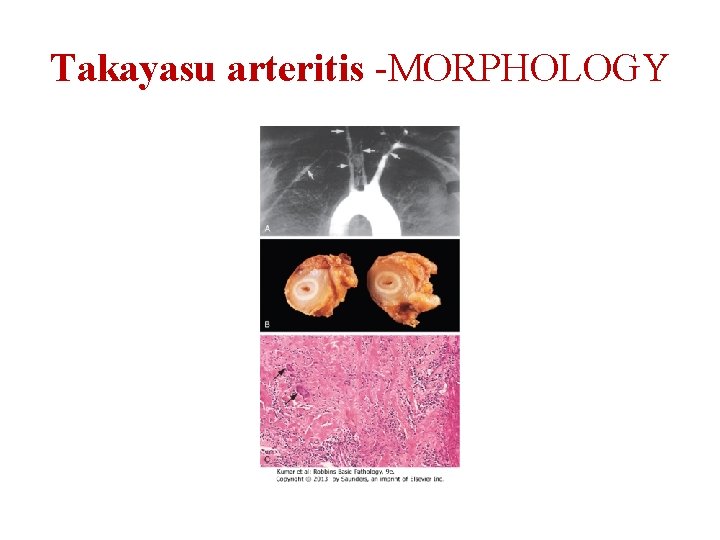 Takayasu arteritis -MORPHOLOGY 